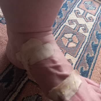 Ayak Kesici Terlik İçin İade Reddi Ve Sağlık Şikayeti