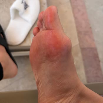 Makarna Servisinde Yanık Oluşması Ve Otel Yönetiminin İlgisiz Tutumu