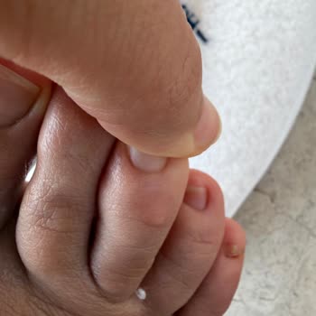 Makarna Servisinde Yanık Oluşması Ve Otel Yönetiminin İlgisiz Tutumu