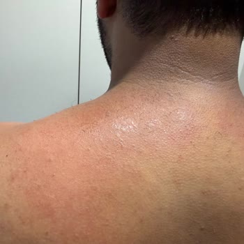 Veet Men Tüy Dökücü Kremde Şiddetli Yanma Ve Güven Kaybı