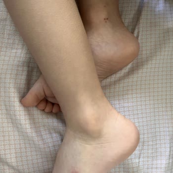 Çocuğumun Ayağını Yaran Sandalet Ve İade Talebi