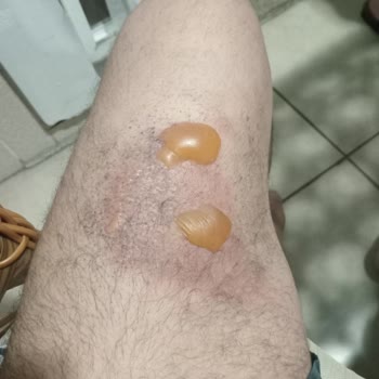 Fakir Temper Çaycının Kulpu Koptu, Kaynar Su Yanıklara Neden Oldu