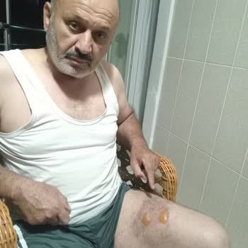 Fakir Temper Çaycının Kulpu Koptu, Kaynar Su Yanıklara Neden Oldu