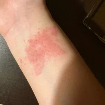 Temporary Tattoos Dövmenin Olduğu Bölgede Kaşıntı Başladı