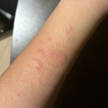 Temporary Tattoos Dövmenin Olduğu Bölgede Kaşıntı Başladı