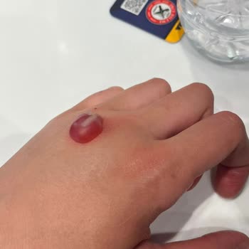 Cildiye Bölümünde Şiddetli Yanma Ve Açık Yara Şikayeti