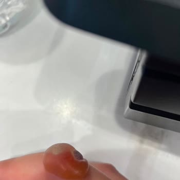 Cildiye Bölümünde Şiddetli Yanma Ve Açık Yara Şikayeti