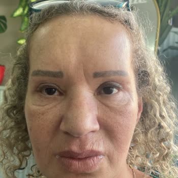 Estemagic Güzellik ve Estetik Merkezi İşlem Sonrası Çift Görme, Bakışlarda Yorgunluk