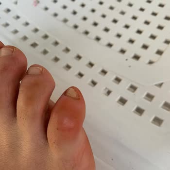 Ayakkabının Ön Bölümü Ağrı, Şişlik Ve Su Toplamasına Neden Oluyor, İade Talebi