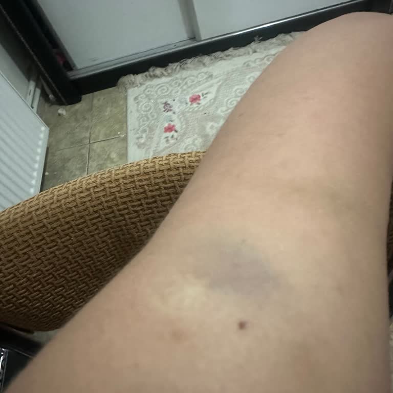 Aşı Uygulamasında Dikkatsiz Hemşire Nedeniyle Şiddetli Ağrı Ve Morluk