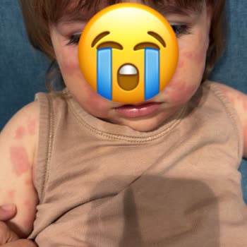 Çocuğumda Ağır Alerjik Reaksiyon Yaratan Losyon Üzerine Acil İnceleme Talebi