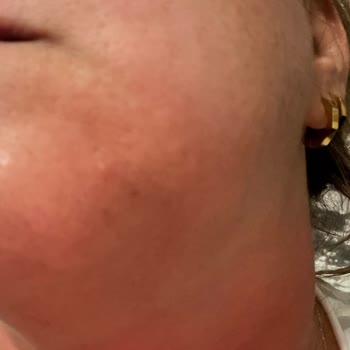 PH Lab Ürünlerinde Şiddetli Yanma Ve Kızarıklık - İade Talebi