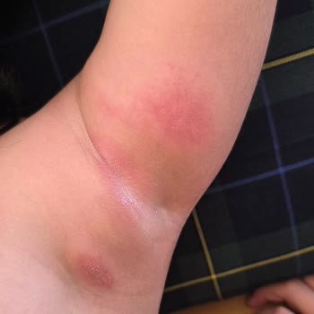 Penti Bikini Setinde Cilt Tahrişi Ve Ücret İadesi Talebi
