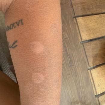Lazer Epilasyon Yanığı Ve Sorumluluk Reddi Nedeniyle Tam İade Talebi