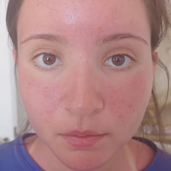 N11 Sebamed Güneş Koruyucu Ürünün Orijinalliği Şüpheli, Çocuğum 2. Derece Yanık Yaşadı