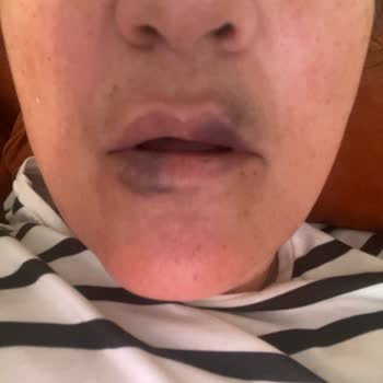 Dudak Dolgusu Sonrası Morarma Ve Yanık, Kliniğin İletişimsizliği Ve Ücret İadesi Talebi