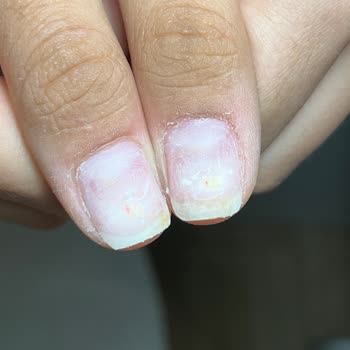 Bonita Nail Salonunda Protez Tırnak Sonrası Hava Alma Ve Mantar Sorunu İhmal Edildi