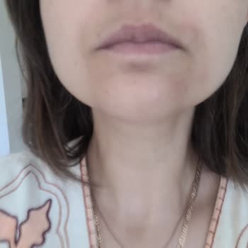 Lazer Epilasyon Sonrası Leke İçin Klinikten Cevapsızlık Ve Masraf İadesi Talebi