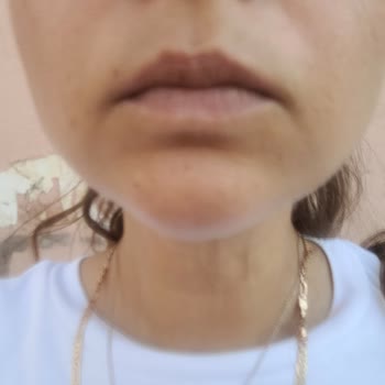 Lazer Epilasyon Sonrası Leke İçin Klinikten Cevapsızlık Ve Masraf İadesi Talebi