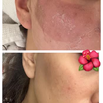 Klinik Tedavisi Sonrası Cilt Lekelerinde Artış Ve Ücret İadesi Talebi