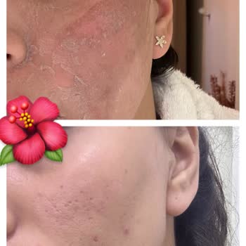 Klinik Tedavisi Sonrası Cilt Lekelerinde Artış Ve Ücret İadesi Talebi