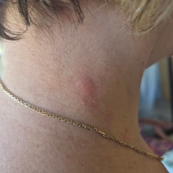 Qsmok İlacı Nedeniyle Şiddetli Alerjik Reaksiyon Ve Cilt Kabartıları