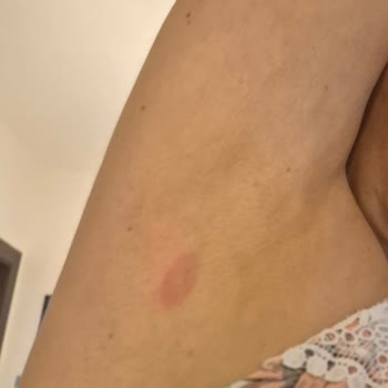 Qsmok İlacı Nedeniyle Şiddetli Alerjik Reaksiyon Ve Cilt Kabartıları
