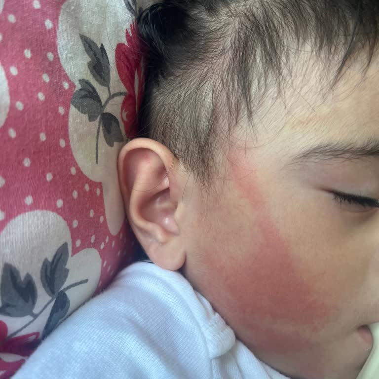 Bebek Saç Spreyinde Hızlı Alerjik Reaksiyon Güven Sorunu