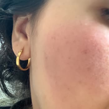 Yves Rocher Ürününden Alerjik Reaksiyon Ve Yetersiz Müşteri Desteği