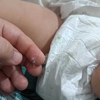 Sleepy 5 Numaralı Bebek Bezinde Tiftiklenme Ve Jel Dağılma Sorunu