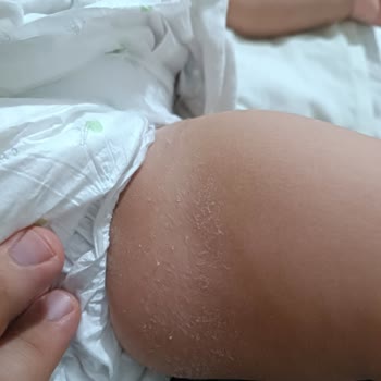 Sleepy 5 Numaralı Bebek Bezinde Tiftiklenme Ve Jel Dağılma Sorunu