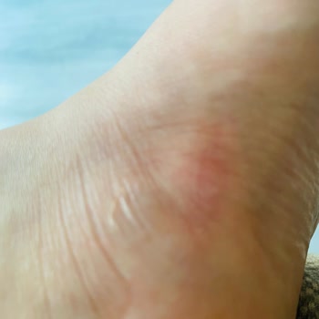 Birkenstock Terliğinde Yanma Ve Kızarıklık İle Karşılaştığım Ağrı Nedeniyle İade