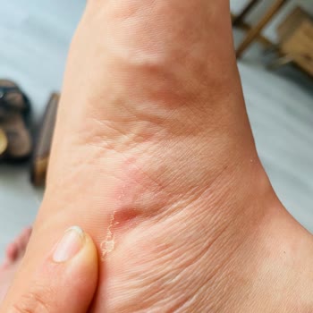 Birkenstock Terliğinde Yanma Ve Kızarıklık İle Karşılaştığım Ağrı Nedeniyle İade