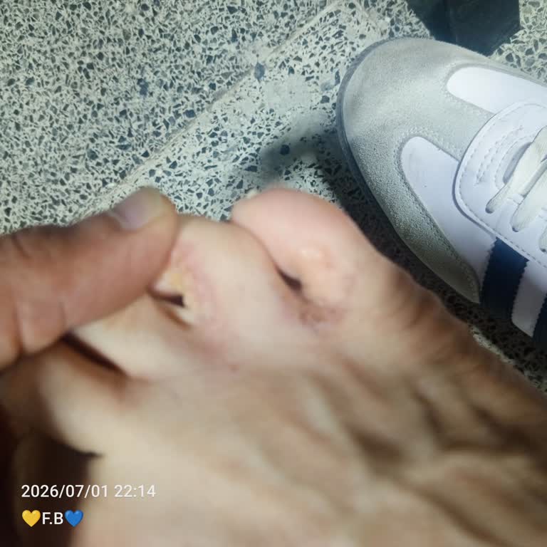 Ayakkabının Malzemesinden Kaynaklanan Cilt Tahrişi Ve Mantar Şikayeti