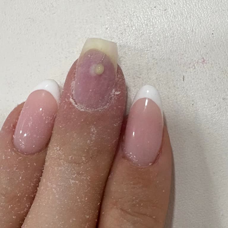 Nail Time | Ataköy Tırnağımı Kırdılar Enfeksiyon Oluştu