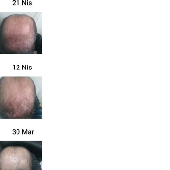 Saç Vitamini Seansları Hiç Fayda Sağlamadı Ve Sözleşme Şartları Aşırı Kısıtlayıcı