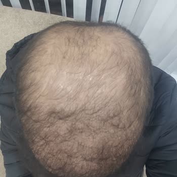 Saç Vitamini Seansları Hiç Fayda Sağlamadı Ve Sözleşme Şartları Aşırı Kısıtlayıcı