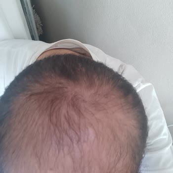 Saç Vitamini Seansları Hiç Fayda Sağlamadı Ve Sözleşme Şartları Aşırı Kısıtlayıcı