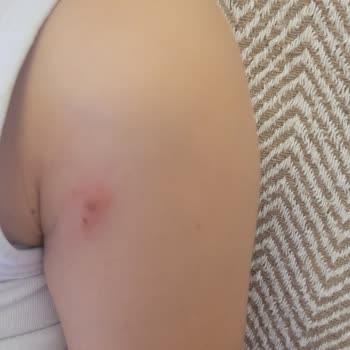 Atopik Ciltli Çocuğumda Mustela Şampuanı Nedeniyle Alerjik Reaksiyon Ve İade Talebi