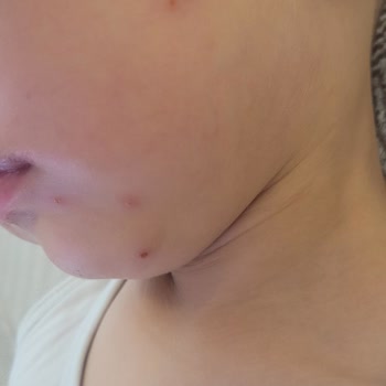 Atopik Ciltli Çocuğumda Mustela Şampuanı Nedeniyle Alerjik Reaksiyon Ve İade Talebi