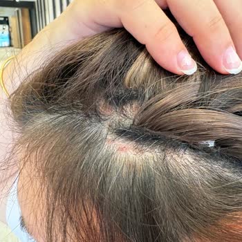 Saç Derisinde Şiddetli Kaşıntı Ve Yaralar Nedeniyle Ücret İadesi Talebi