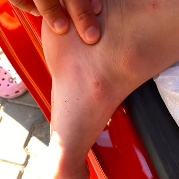 Çocuk Terliği Koptu Ve Yaralandı, Mağaza İadeyi Reddetti