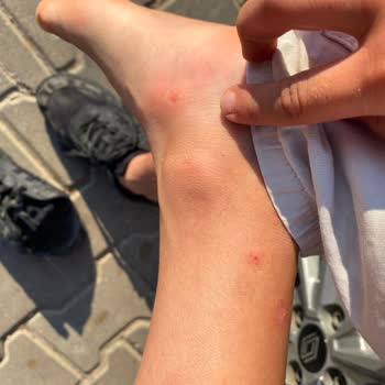 Çocuk Terliği Koptu Ve Yaralandı, Mağaza İadeyi Reddetti