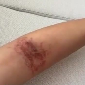 Ordu Devlet Hastanesi Serum Takılması Nedeniyle Kolum Yandı