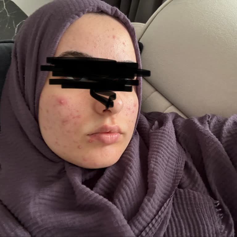 Bioderma Spot SPF 50 Güneş Kremi Nedeniyle Ciltte Akne Ve Kızarıklık, İade Talebi