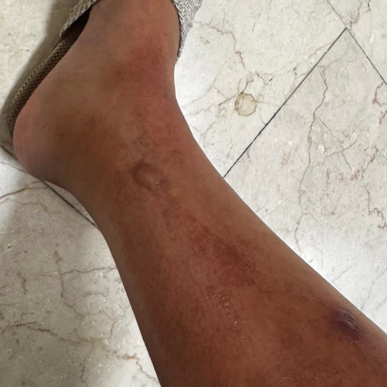 Akgün Otel'de Yetersiz İlaçlama Sonucu Şiddetli Dermatit Ve Yanık Acısı