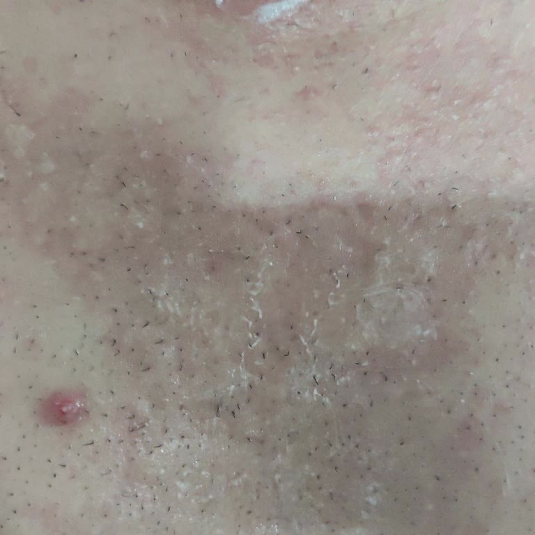 Remove Tüy Dökücü Men Jel Kullanımından Şiddetli Cilt Yanığı