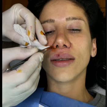 Op. Dr. Hakan Teymur Hatalı Liplift Operasyonları Sonrası Belirgin İz Ve Doktorun Kaba Tutumu
