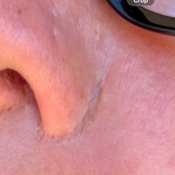 Op. Dr. Hakan Teymur Hatalı Liplift Operasyonları Sonrası Belirgin İz Ve Doktorun Kaba Tutumu