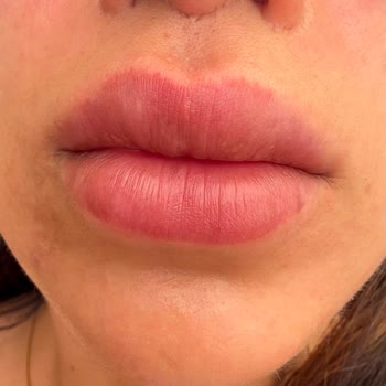 Op. Dr. Hakan Teymur Hatalı Liplift Operasyonları Sonrası Belirgin İz Ve Doktorun Kaba Tutumu